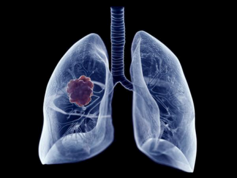 肺癌个性化用药解决方案