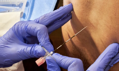 医械科普 | 一次性使用神经阻滞穿刺针：精准、可靠，助力安全麻醉管