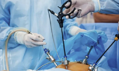 医械科普丨零出血、零拆线：腔镜吻合器带你体验无痕内脏缝合术